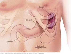 Splenomegaly-e-readmedia