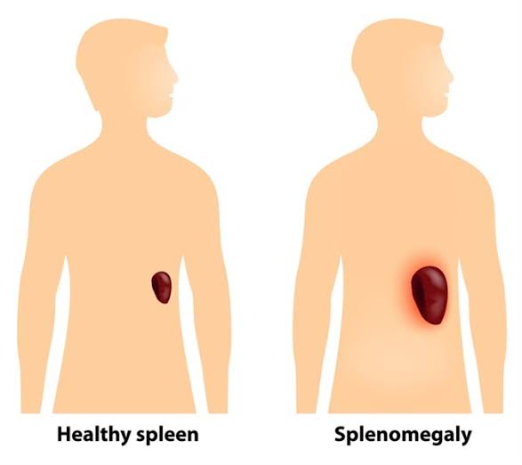 Signs and symptoms of Splenomegaly 